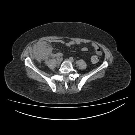 Perforated appendicitis with abscess formation | Image | Radiopaedia.org