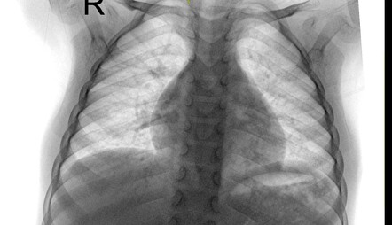 Bifid rib | Image | Radiopaedia.org