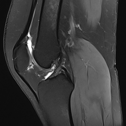 Synovial hemangioma | Radiology Case | Radiopaedia.org