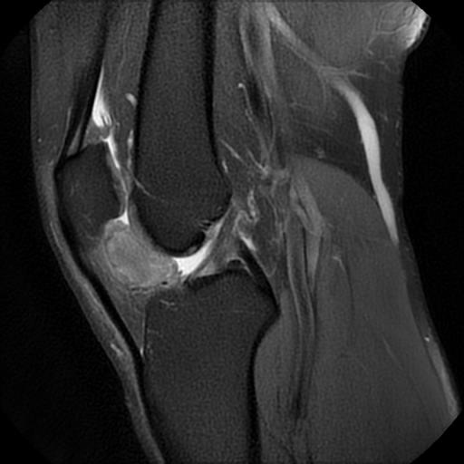 Intracapsular chondroma - knee | Image | Radiopaedia.org