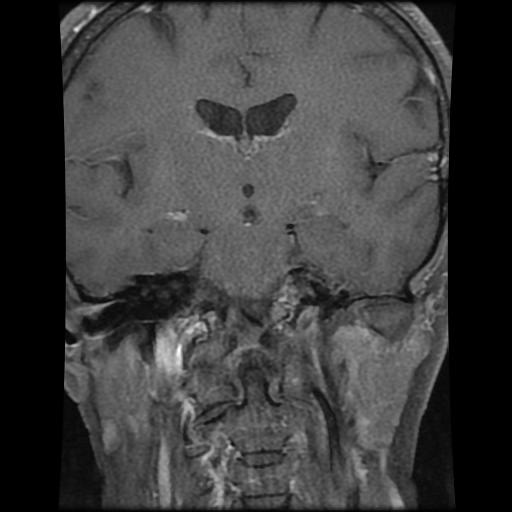 Meningiomas Cavernous Sinus And Temporal Image Radiopaedia Org Hot Sex Picture