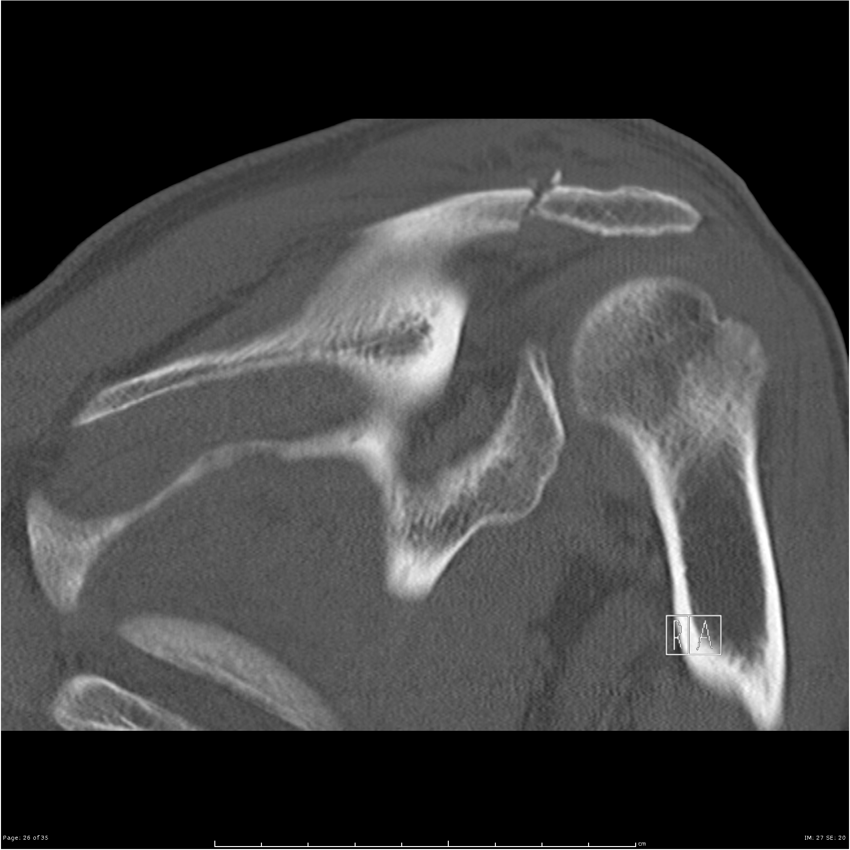 Acromial Fracture Image