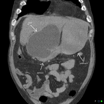 Pancreatic pseudocyst causing gastric outlet obstruction | Radiology ...