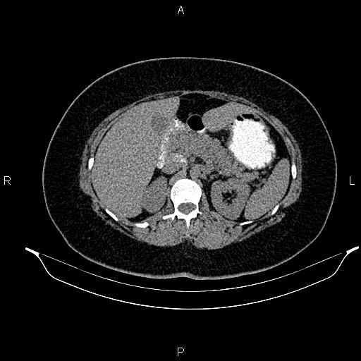 Intestinal Malrotation | Image | Radiopaedia.org