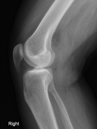 Elongated lower pole of the patella | Radiology Case | Radiopaedia.org