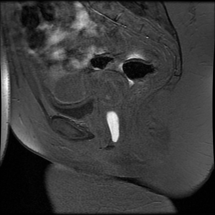 Gartner duct cyst | Image | Radiopaedia.org