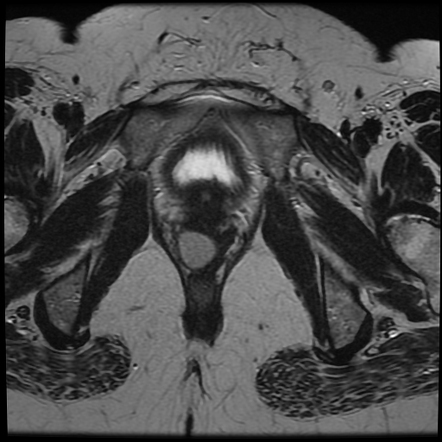 Gartner duct cyst | Image | Radiopaedia.org