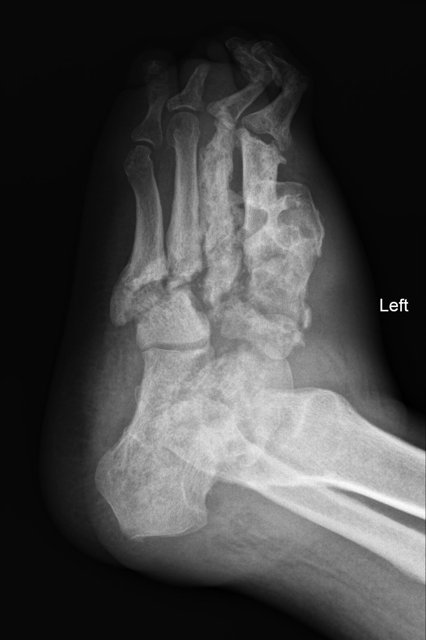 Charcot foot | Image | Radiopaedia.org