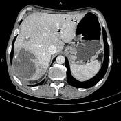 Hepatic Abscess Radiology Reference Article Radiopaedia Org