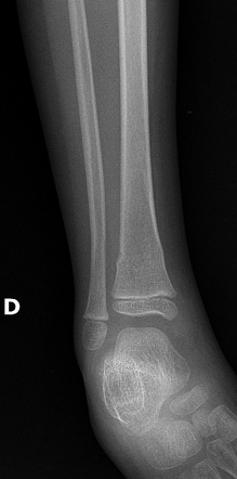 Tibial torus fracture and fibular bowing | Image | Radiopaedia.org