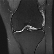 Iliotibial band syndrome | Radiology Reference Article | Radiopaedia.org