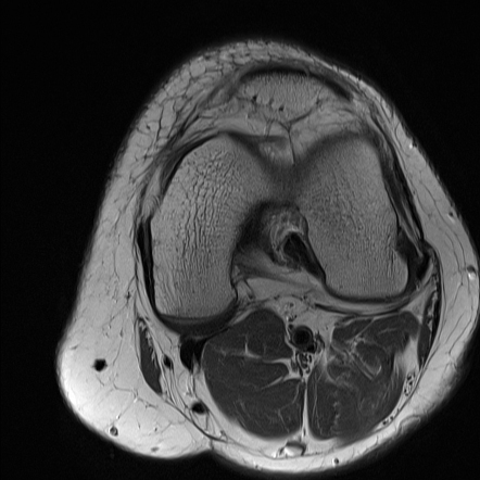 Anterior suprapatellar fat pad impingement syndrome | Image ...