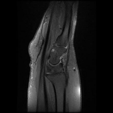 De Quervain tenosynovitis | Image | Radiopaedia.org