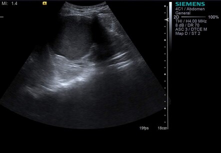 Calyceal diverticulum | Image | Radiopaedia.org