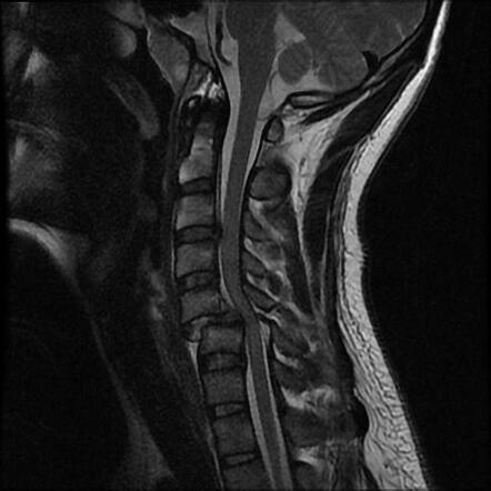 Fracture dislocation C5/6 | Radiology Case | Radiopaedia.org