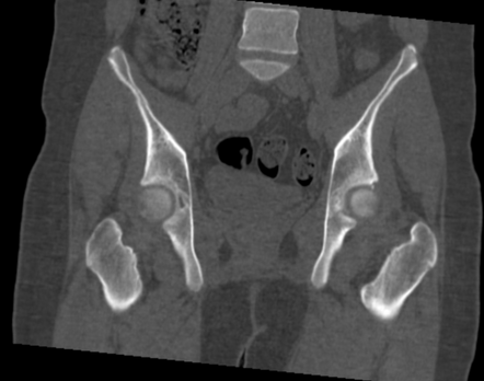 Slipped upper femoral epiphysis | Image | Radiopaedia.org