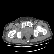 Prostatic abscess | Radiology Reference Article | Radiopaedia.org