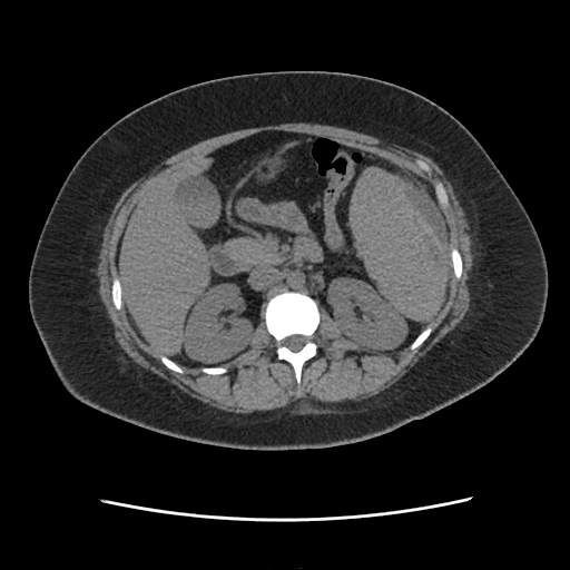 Splenic Subcapsular Hematoma Image