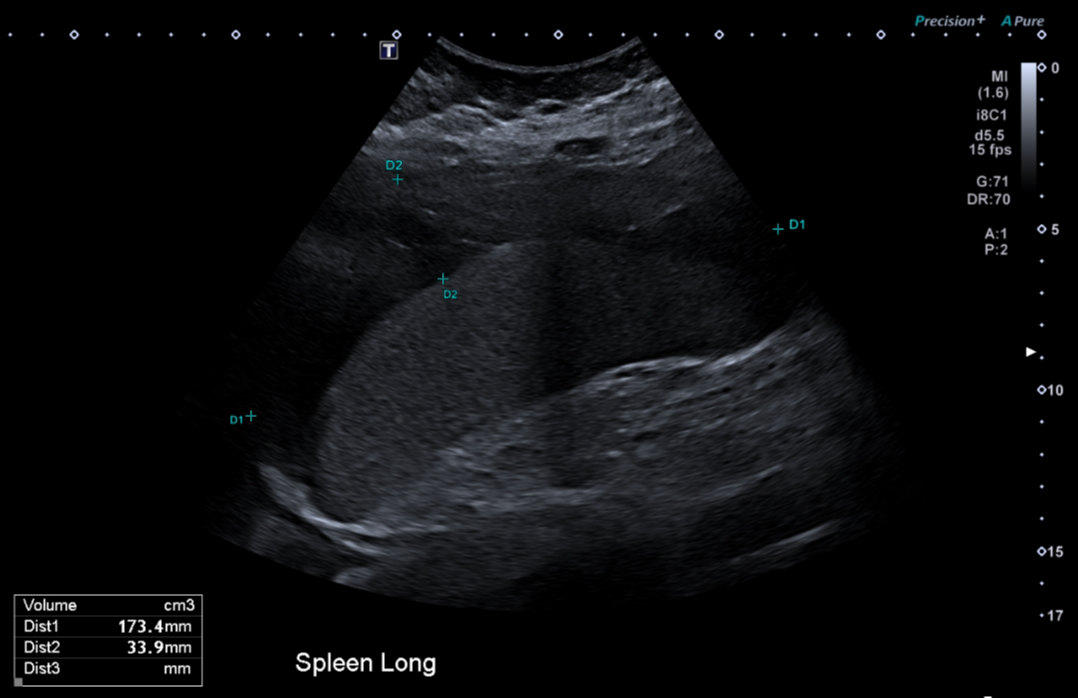 Splenic subcapsular hematoma | Image | Radiopaedia.org