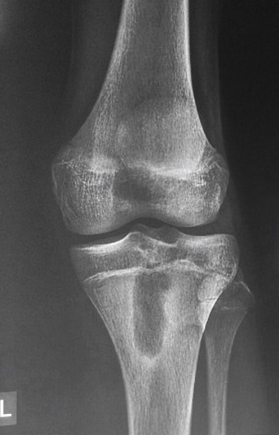 Brodie abscess Radiology Reference Article Radiopaedia