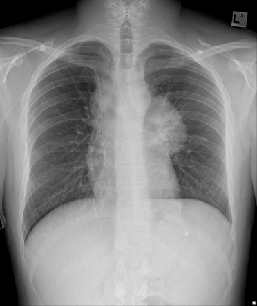 Primary Mediastinal B-cell Lymphoma | Radiology Case | Radiopaedia.org