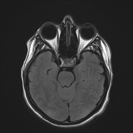 Posterior reversible encephalopathy syndrome with transient cortical ...