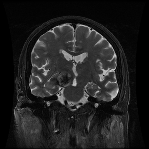 Ruptured aneurysm of supraclinoid internal carotid artery with ...