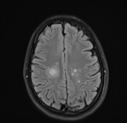 Baló concentric sclerosis | Image | Radiopaedia.org