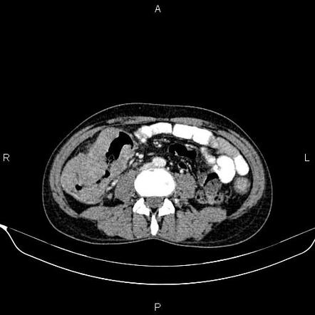 Diffuse large B-cell lymphoma of the colon | Radiology Case ...