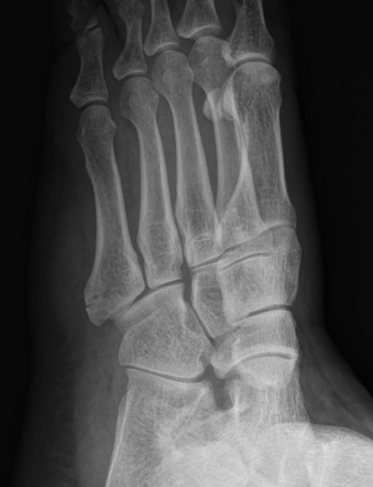 Avulsion fracture of the 5th metatarsal styloid | Radiology Reference ...