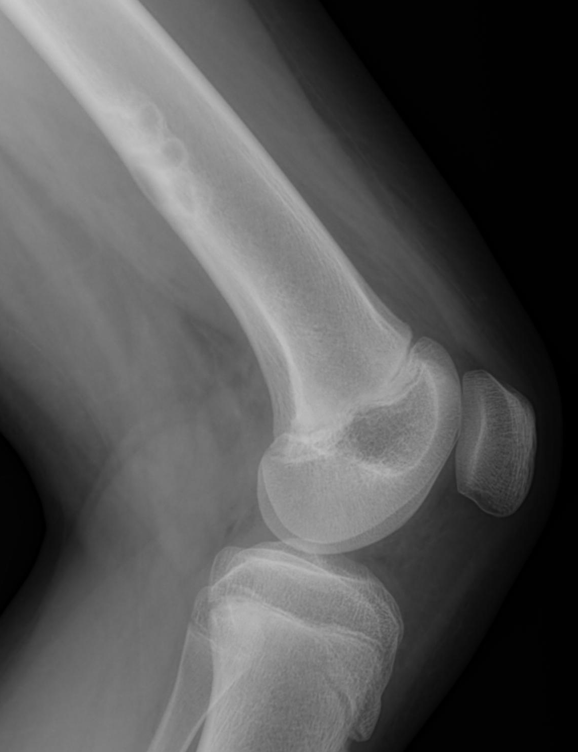 Ossifying fibroma | Image | Radiopaedia.org