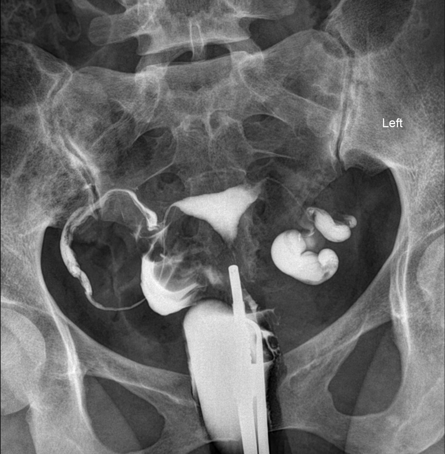 Unilateral tubal block and hydrosalpinx | Image | Radiopaedia.org