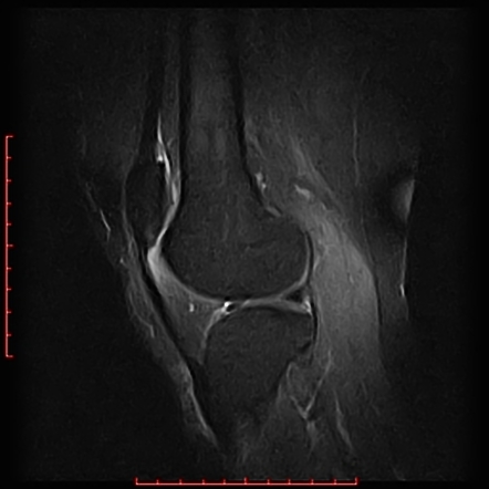 Patellar tendon-lateral femoral condyle friction syndrome, Radiology  Reference Article