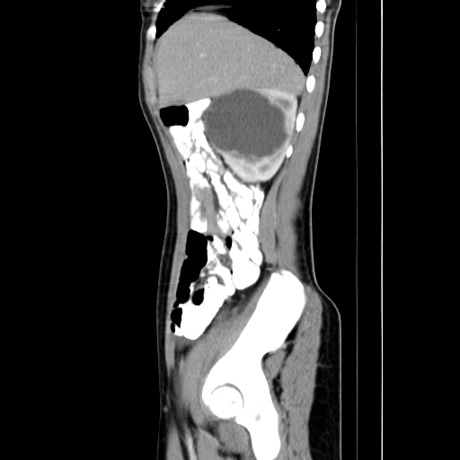 Calyceal diverticulum | Image | Radiopaedia.org