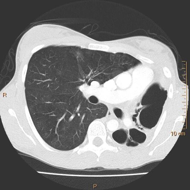 Unilateral tuberculous lung destruction | Radiology Case 