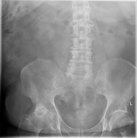 Gallstone ileus - radiolucent gallstone | Radiology Case | Radiopaedia.org