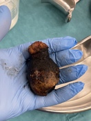 gallstone | Search | Radiopaedia.org