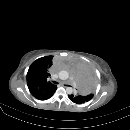 HIV-related Primary Mediastinal Large B-cell Lymphoma With ...