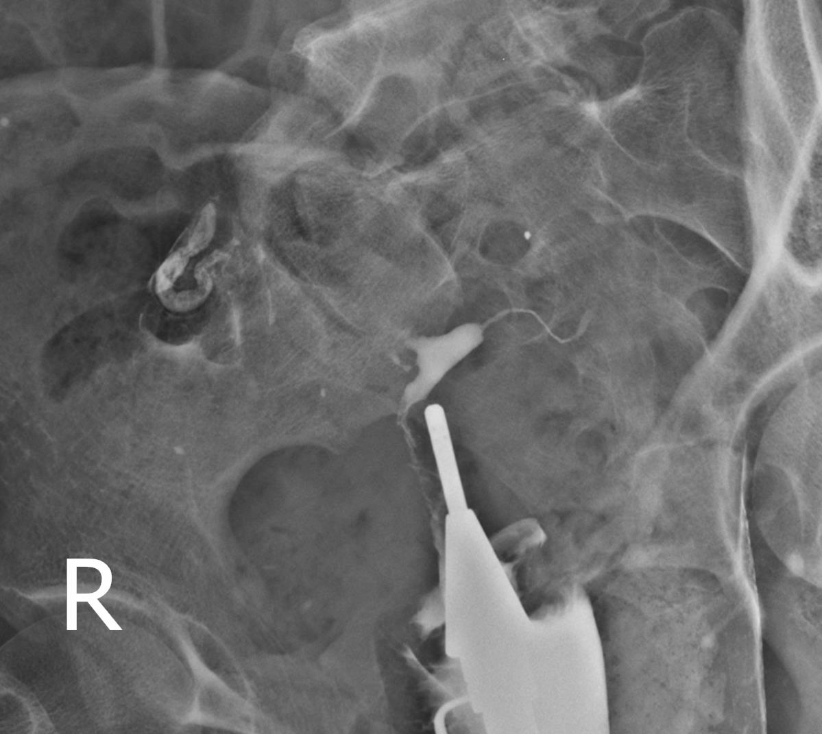 Asherman syndrome and left tubal block | Image | Radiopaedia.org