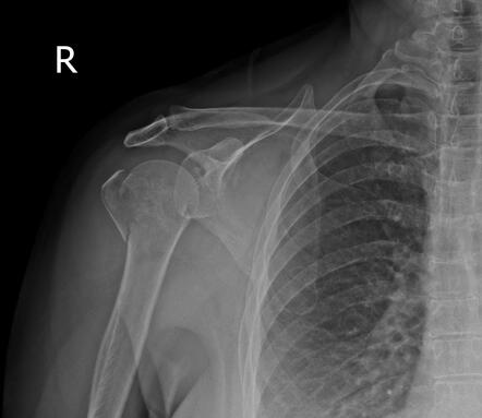 Humeral greater tuberosity avulsion fracture | Radiology Case ...