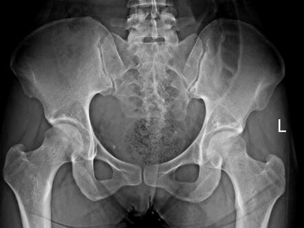 Sacral fracture | Radiology Case | Radiopaedia.org