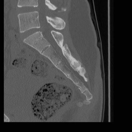 Sacral fracture | Image | Radiopaedia.org