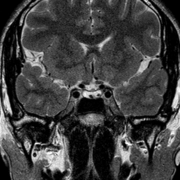 Rathke Cleft Cyst With Intracystic Nodules Image 2645