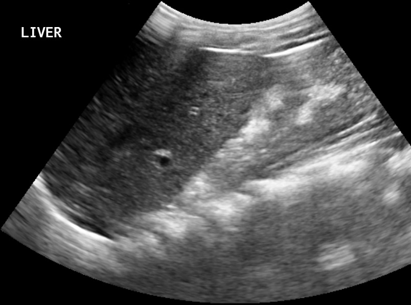 Crossed Fused Renal Ectopia Image