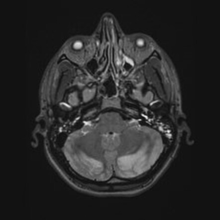 Fentanyl-induced hypoxic encephalopathy | Radiology Case | Radiopaedia.org