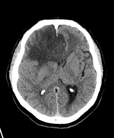 Astrocytoma, IDH-mutant - grade 4 | Radiology Case | Radiopaedia.org