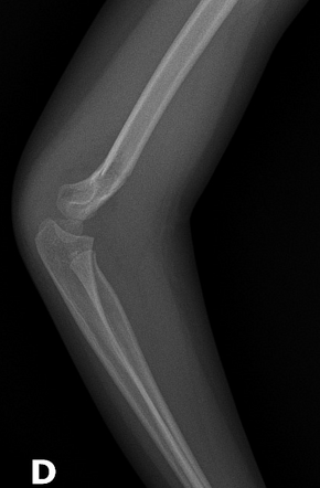 Supracondylar fracture - Gartland type II | Radiology Case ...