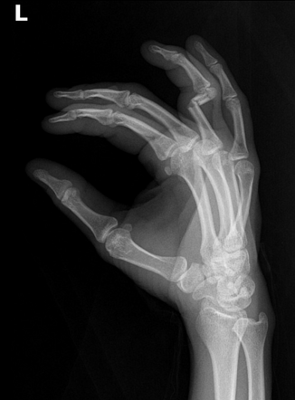 Proximal Phalanx Fracture Radiology Case Radiopaedia Org