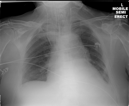 Internal jugular line - misplaced | Radiology Case | Radiopaedia.org