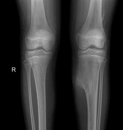 Osteochondroma - tibia | Radiology Case | Radiopaedia.org